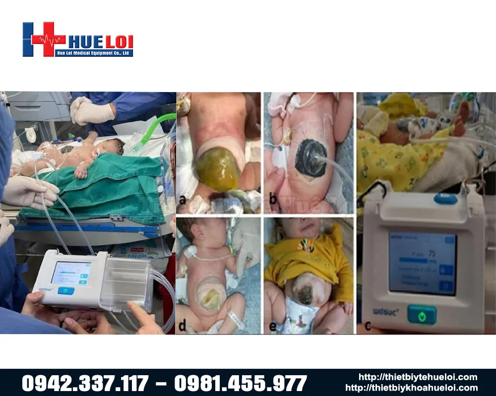 hình ảnh điều trị vết thương loét bằng máy RH-100