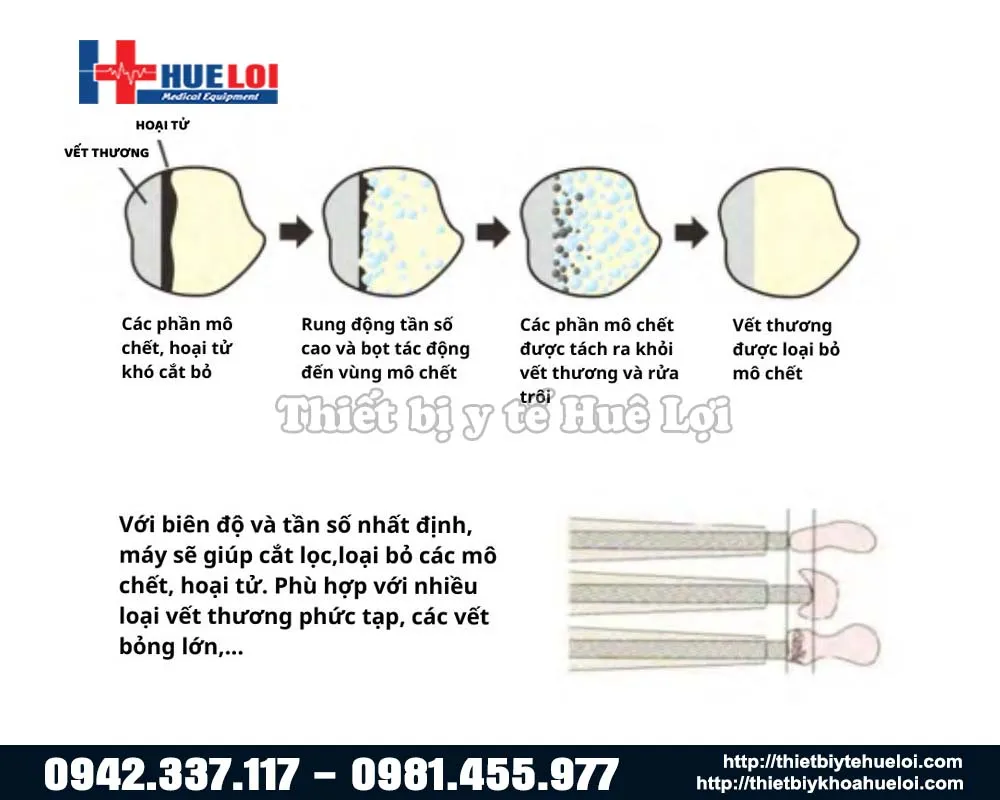 cơ chế vi bọt của máy siêu âm cắt bỏ vết thương