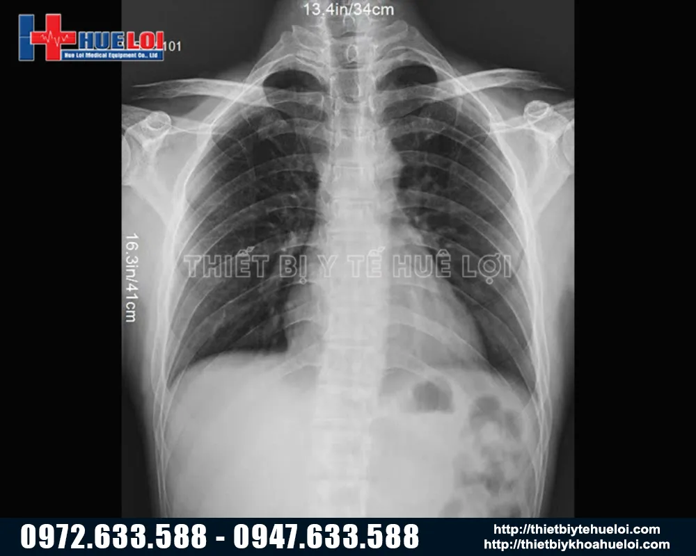 Hình ảnh thực tế của máy X-Quang Yolong