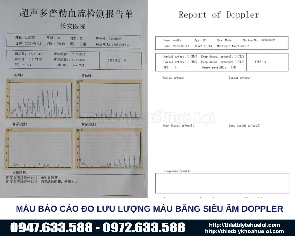 Mẫu kết quả của máy đo rối loạn sinh lý nam giới