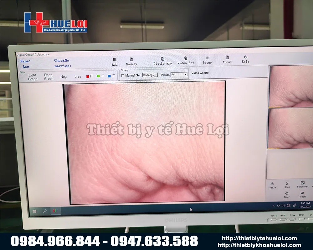 Hình ảnh của máy soi cổ tử cung sw302