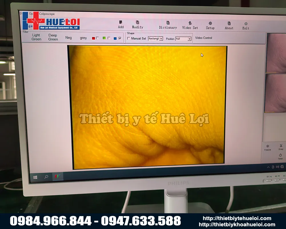 Chất lượng hình ảnh của máy soi cổ tử cung sw302