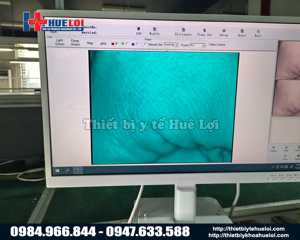 Hình ảnh thực tế của máy soi cổ tử cung