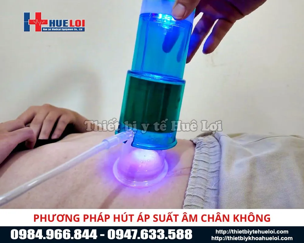 Phương pháp điều trị hút áp suất âm chân không